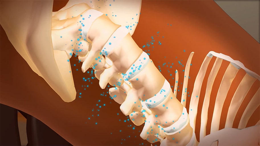Herniated disc - Inverting helps relieve back pain by hydrating the discs in your vertebrae.