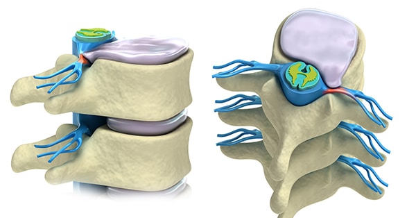 Herniated Disc