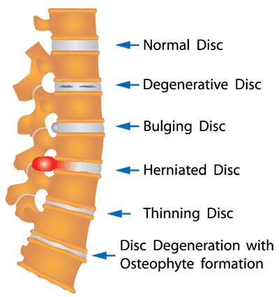 Degenerative Disc Disease